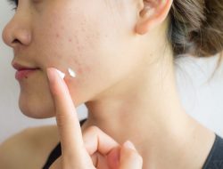Begini Cara Hilangkan Jerawat Menggunakan Skincare