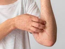 Tips Cegah Penyakit Kulit di Musim Pancaroba dari Dinkes Makassar